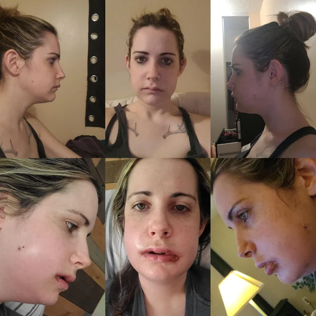 ما هي الرعاية الخاصة بعد جراحة الفك؟