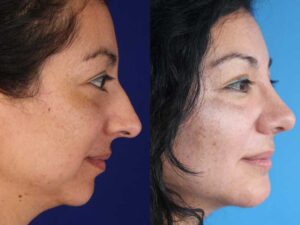 الفرق الرئيسي بين جراحة الفك وجراحة الذقن