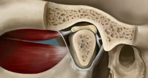 أعراض اضطراب المفصل الصدغي الفكي (TMJ)