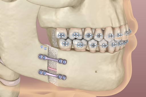 أسباب وتشخيص ارتخاء برغي الفك بعد الجراحة