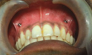 علاج مشكلة ارتخاء برغي الفك بعد الجراحة