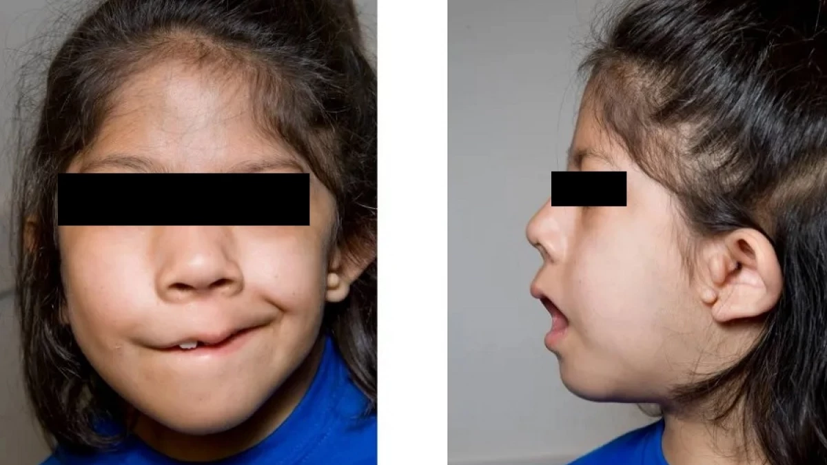 جراحة صغر حجم نصف الوجه عند الأطفال في إيران