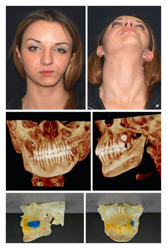 جراحة صغر حجم نصف الوجه في طهران للأطفال والكبار