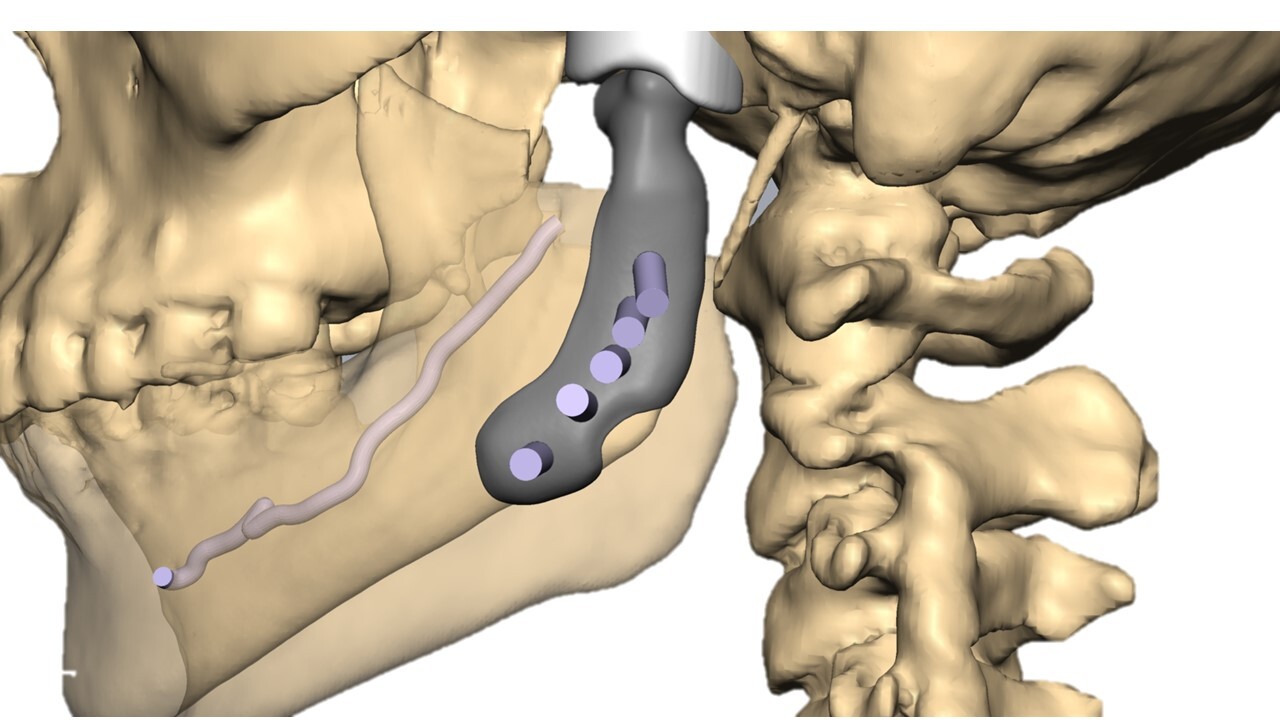 طقم اصطناعي لاستبدال المفصل في الكسور الثنائية لمفصل الفك