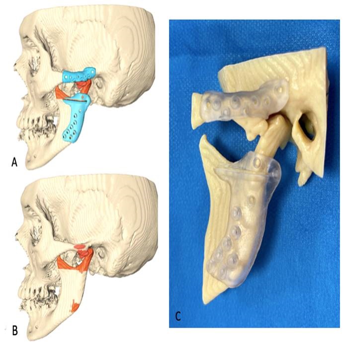 طقم اصطناعي لاستبدال المفصل في الكسور الثنائية لمفصل الفك