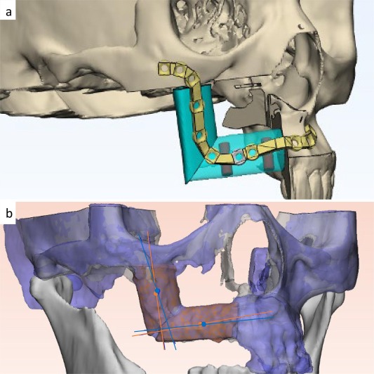 ترقيع الأوعية الدموية الدقيقة في الفك بواسطة الدكتور شهاب الدين عزيزي