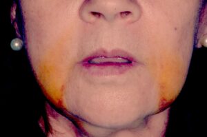 كيفية علاج العدوى بعد جراحة الفك؟