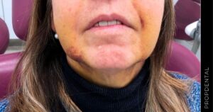 ما هي العلامات المباشرة لعدوى جراحة الفك؟