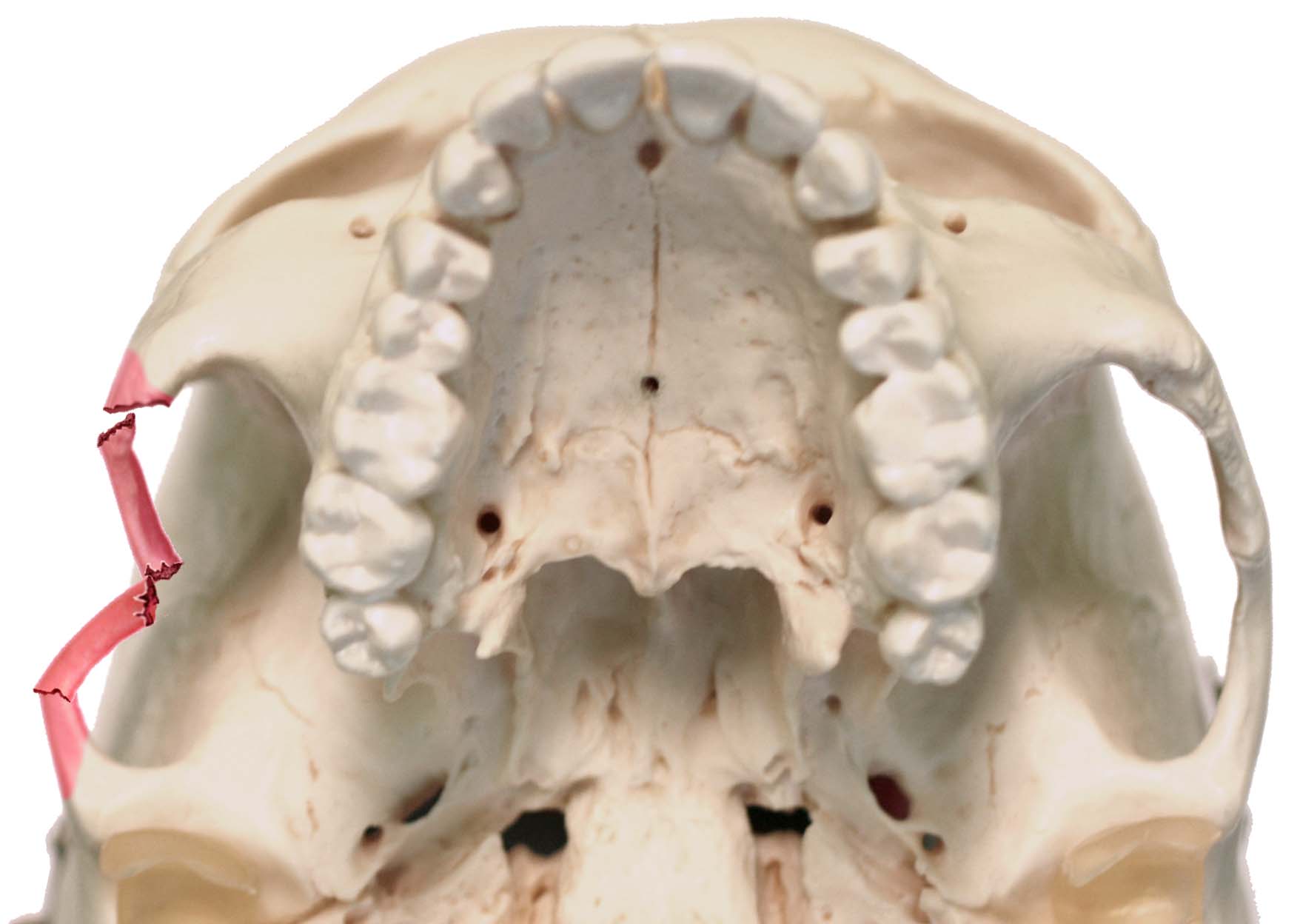 جراحة كسر الفك العلوي في عيادة الدكتور شهاب الدين عزيزي