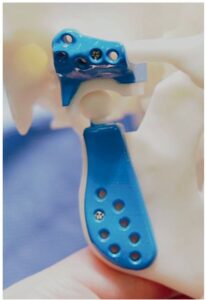 استخدام الأطراف الصناعية الجاهزة في كسور مفصل الفك الثنائي