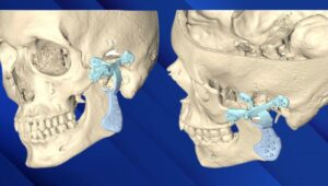 استخدام الغرسات الجاهزة في إصابات المفصل الصدغي الفكي الثنائي