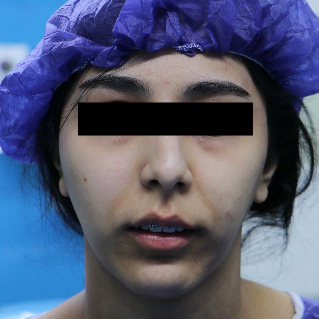 استبدال مفصل الفك وجراحة الفك في وقت واحد