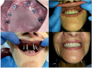 مثال على عملية تطعيم الغرسة تحت السمحاق