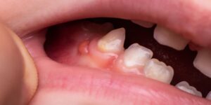 تشخيص الأورام الحميدة والخبيثة عن طريق الخزعة لدى الأطفال والمراهقين