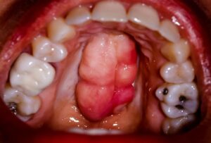تشخيص وعلاج أورام الفك والفم عند الأطفال