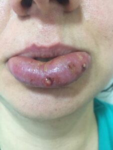 كيفية تسريع شفاء التورم بعد جراحة الفك؟