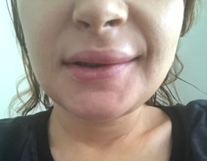 كم من الوقت يستغرق تورم الشفاه ليختفي بعد جراحة الفك؟