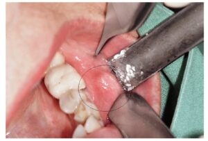 طريقة خزعة الوجه والفكين للأطفال المصابين بأورام خبيثة