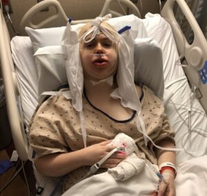 الطريقة الصحيحة للراحة والنوم بعد جراحة الفك