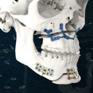 لماذا يتم استخدام الصفائح في جراحة الفك؟