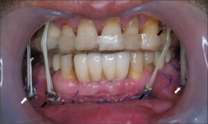 لماذا يتم وضع البراغي في الفك؟ شرح الدكتور عزيزي لسبب استخدام البراغي في الفك