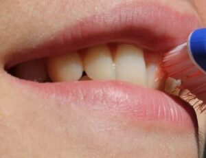 الطريقة الصحيحة لتنظيف الأسنان بالفرشاة بعد جراحة الفك