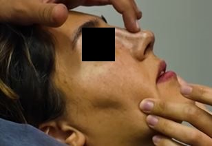 عملية تجميل الأنف في طهران على يد الدكتور شهاب الدين عزيزي