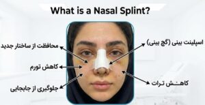 وضع جبيرة أنفية بعد العملية