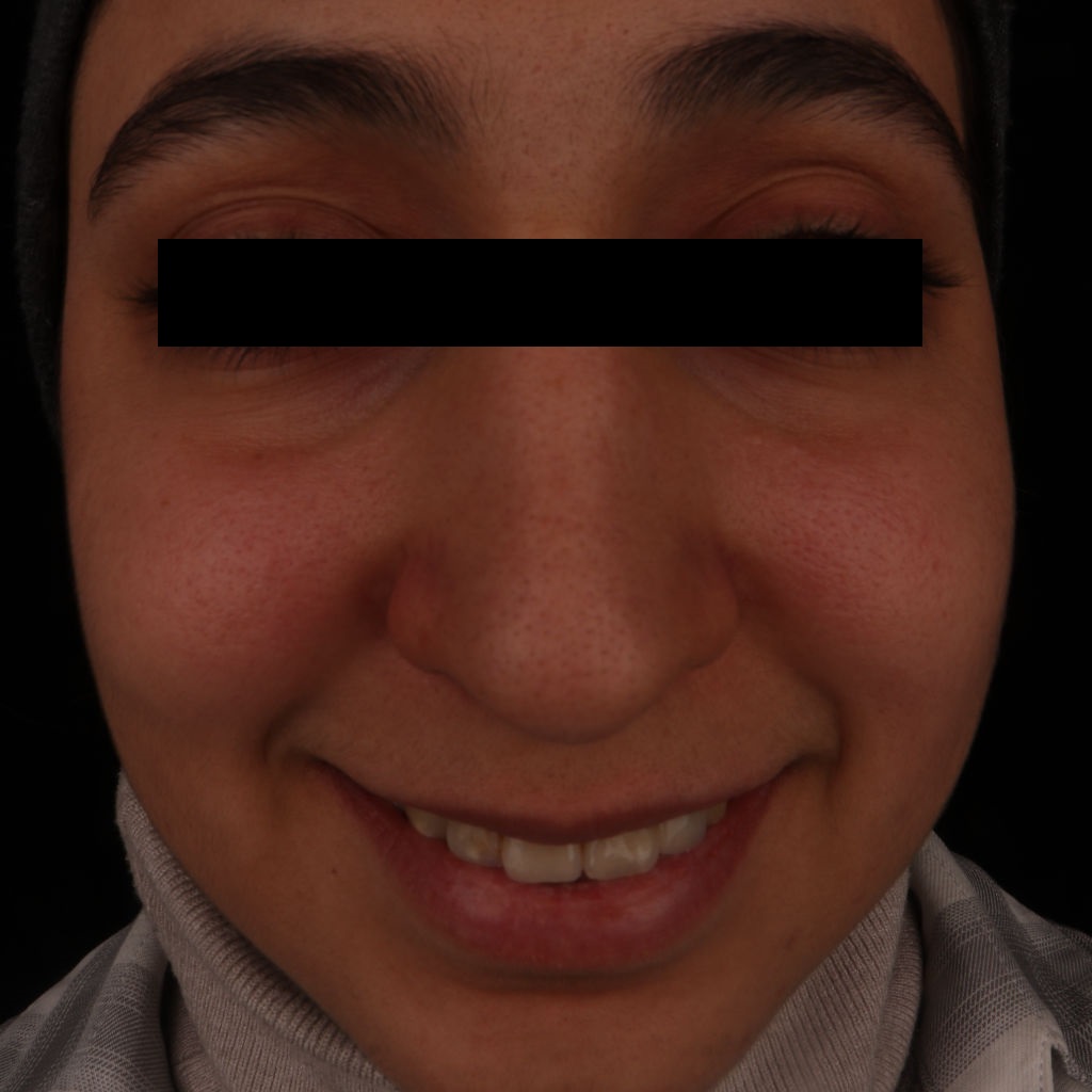 صورة قبل عملية تجميل الأنف الطبيعي