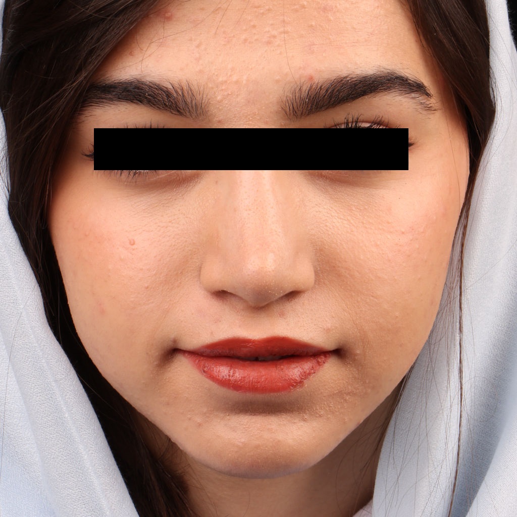 نموذج للنتيجة وصورة بعد عملية تجميل الأنف الطبيعية