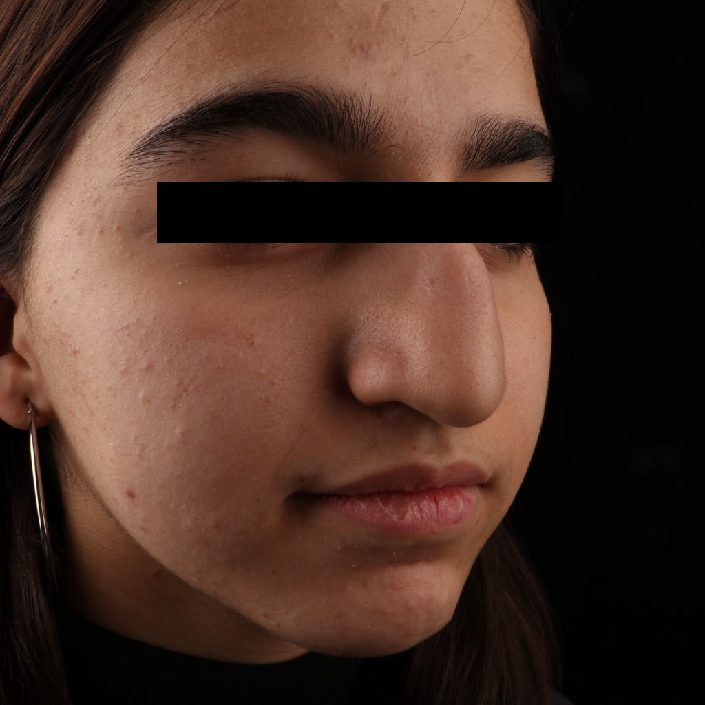 صورة للمريض قبل عملية تجميل الأنف الطبيعية