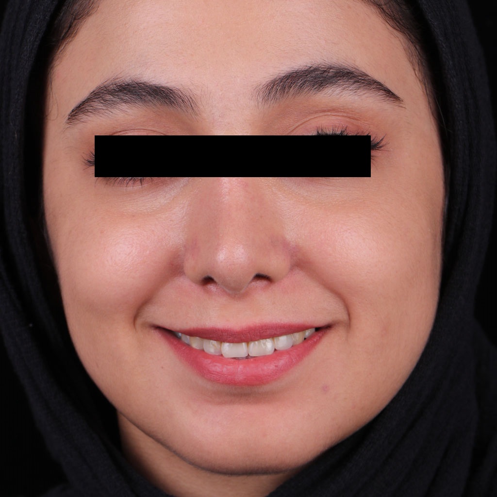صورة بعد عملية تجميل الأنف الطبيعية