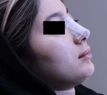 تعليمات حول كيفية العناية بالأنف بعد عملية تجميل الأنف من تقديم الدكتور شهاب الدين عزيزي.